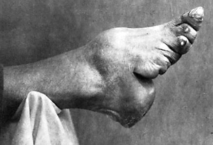 Chinese foot binding images